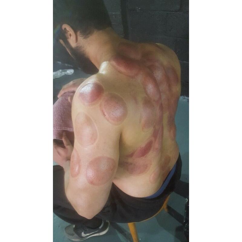CUPPING THERAPY ( CUPPING + MASSAGE ) ?25